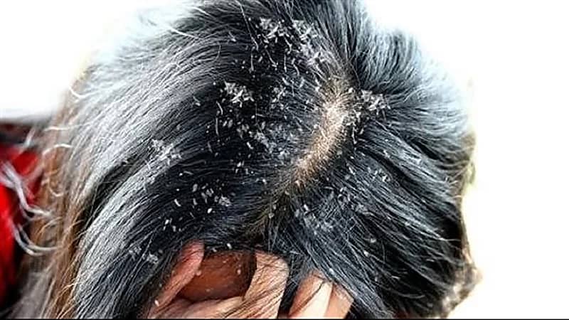أبرزها السمنة والاكتئاب.. مشكلات صحية تسبب زيادة قشرة الرأس