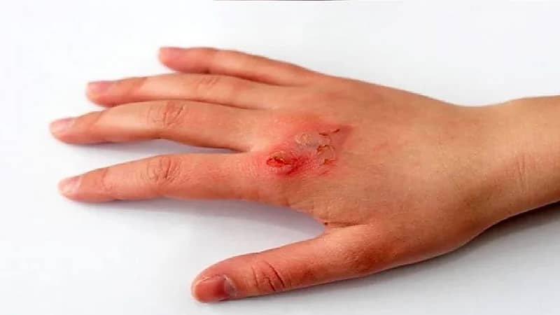 "سعود الطبية" تحذر من وضع بياض البيض النيء على الحروق