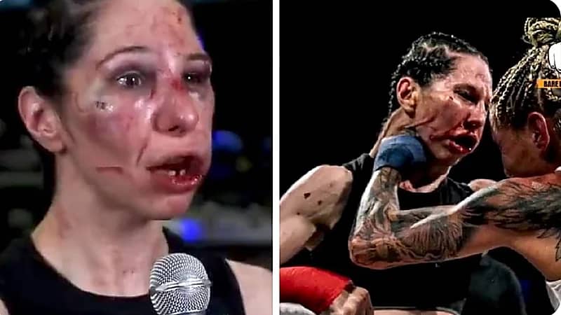 لاعبة ملاكمة بعد خسارتها وتورم وجهها وفقدان أسنانها: أتطلع للقاء خصمي مجدداً.. فيديو