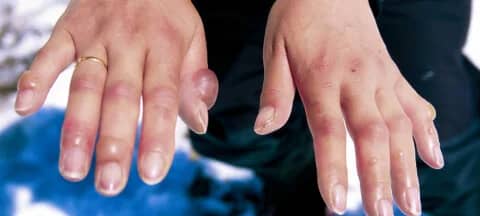 تحذير طبي: قضمة البرد قد تؤدي إلى الغرغرينا والبتر .. فيديو