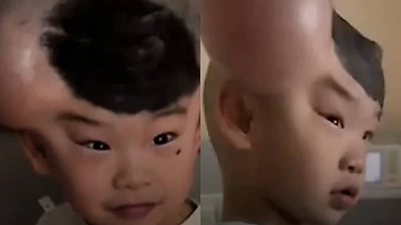 طفل صيني يُلقب بـ ميكي ماوس بسبب وحمتين نادرتين على رأسه .. فيديو