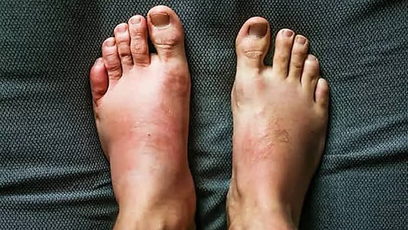 تورم القدمين في الصيف: أسباب شائعة ونصائح فعّالة للتخفيف