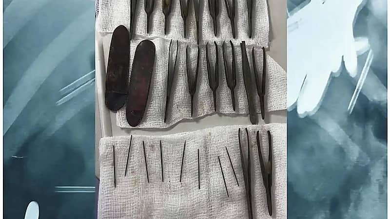 شاب يبتلع 24 ملقط شعر وإبرة.. صور