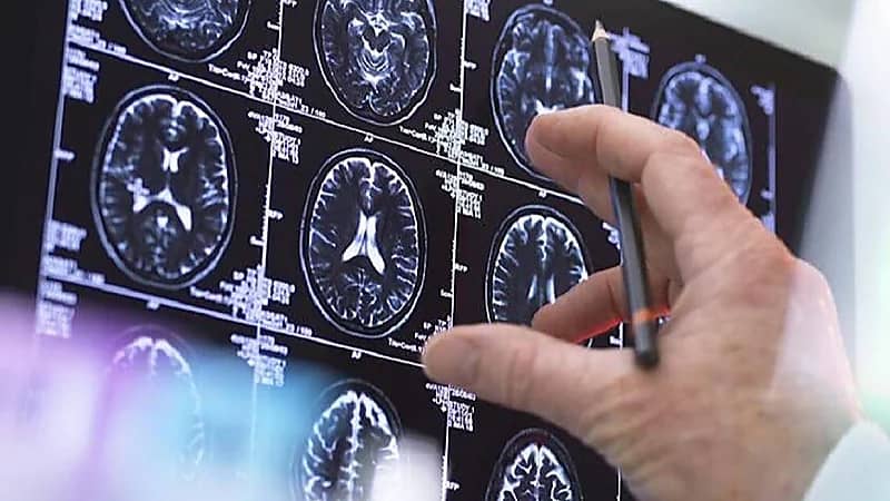 أخصائية أورام: الروائح الكريهة قد تشير لوجود ورم في الدماغ