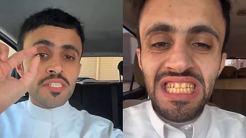شاب يحذر: شوفوا أسناني انتبهوا من التقويم.. فيديو