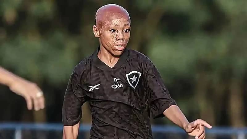 قصة لوبيز: من الحروق المروعة إلى الملاعب البرازيلية