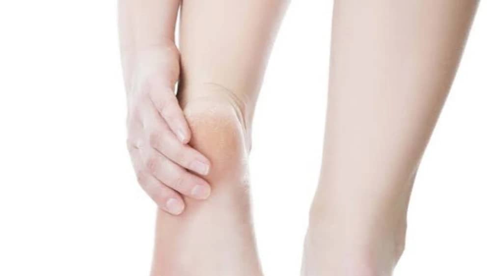 11 عاملًا شائعًا وراء تشقق الكعبين