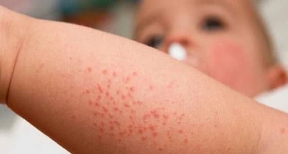 " الصحة " : شفاء جميع الحالات المصابة بـ " الجرب " في مكة