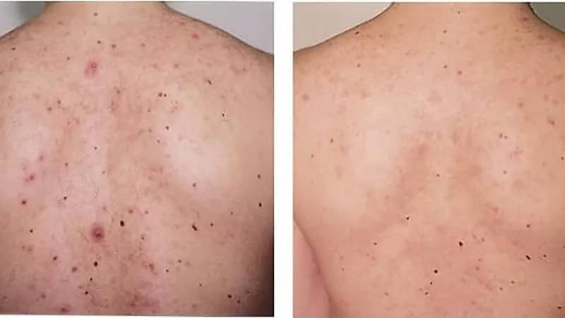 بالفيديو.. طبيب يوضح علاقة بعض الأطعمة بزيادة حبوب الظهر