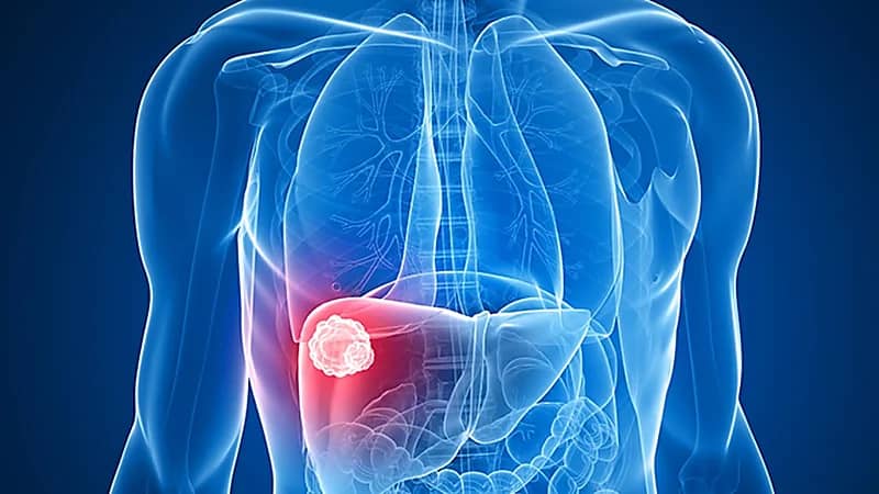 علامات عادية تنبهك بالإصابة بسرطان الكبد