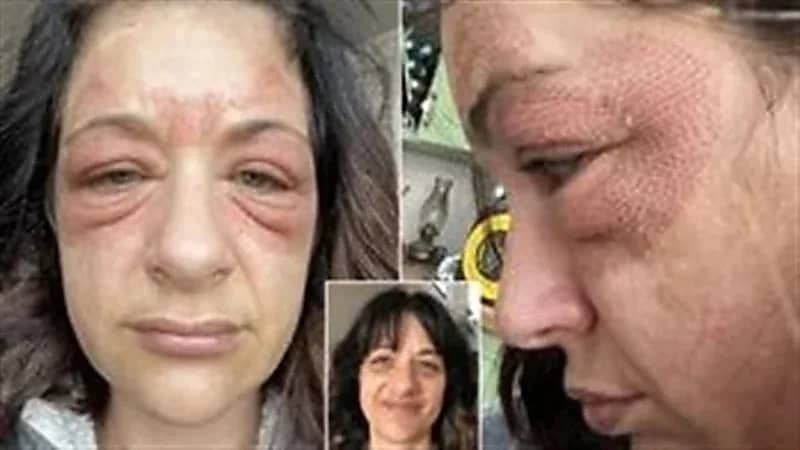 بالصور.. جهاز تجميل يشوه وجه سيدة