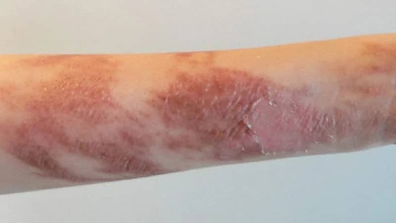 الأقراص المهدئة تتسبب في حرق جلد فتاة ودخولها في غيبوبة