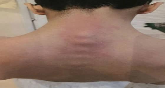 بالفيديو..والد الطالب المعنف والمصاب بإنزلاق فقراته يُكذب تعليم عسير