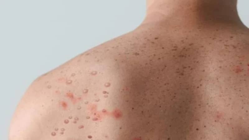 عالم فيروسات: 95% من مصابي جدري القرود يمارسون المثلية الجنسية