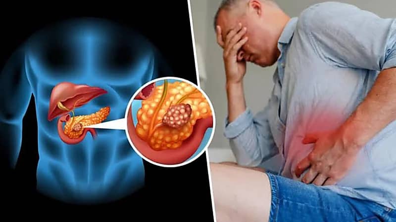 علامات تدل على الإصابة بسرطان البنكرياس