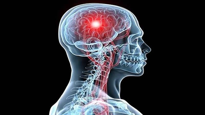 العلامات الأولى للإصابة بالجلطة الدماغية