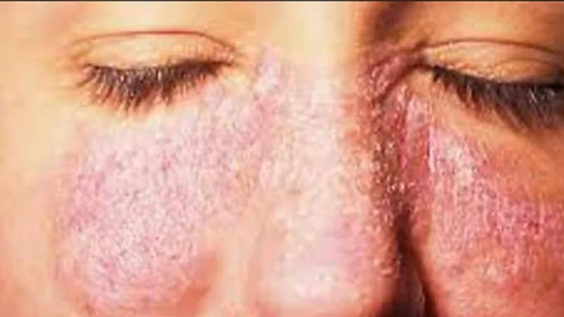 أبرز أعراض مرض الذئبة الحمراء