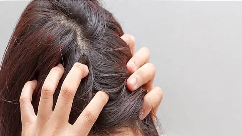 مختصة: الأسيتون مضر لفروة الرأس و"الاكستنشن" قد يسبب الصلع