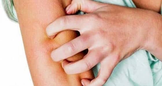 "  المطلق  " يحذر الآباء من الوقوع في الإثم مع انتشار الجرب