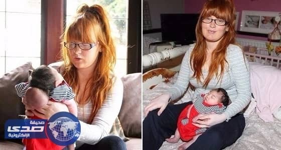 ولادة نادرة لطفلة دماغها خارج الجمجمة