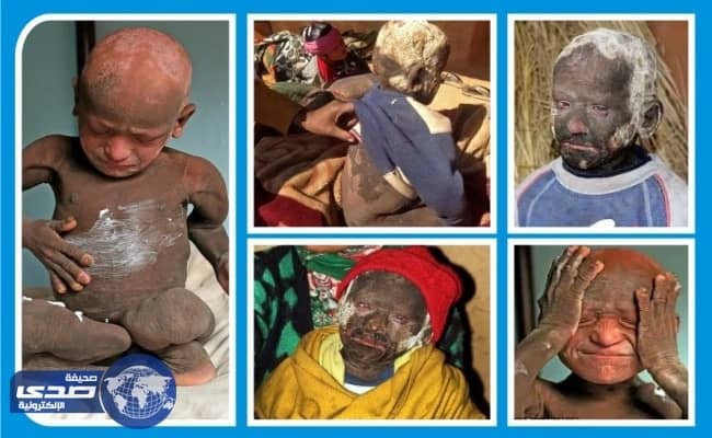 بالفيديو والصور.. مرض جلدي نادر يحول طفل هندي لصخره ويحرمه من طفولته