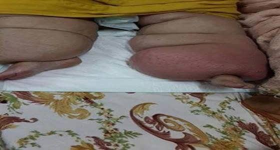 داء الفيل يفتك بجسد مسنة ..ونجلها يناشد المسؤولين بالمساعدة