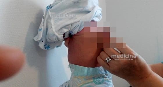 بالصور.. ولادة نادرة لطفل بعضو ذكري اضافي على ظهره