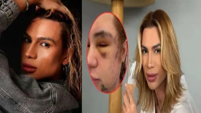 وفاة مؤثر برازيلي بعد عملية تجميل مثيرة للجدل