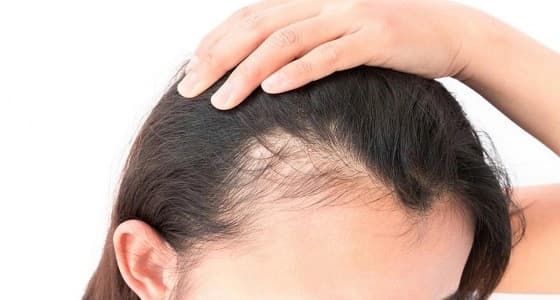 أطباء: علاجات تساقط الشعر تحولك لأنثى مشعرة