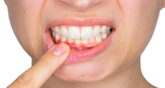 أهمية استشارة الطبيب عند حدوث التهاب اللثة