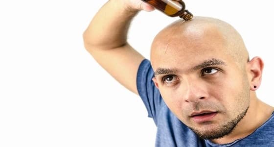 تعرف على أغرب حل لعلاج الصلع