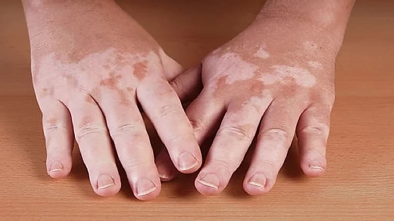 فيتامينات ومعادن مهمة لمرضى البهاق