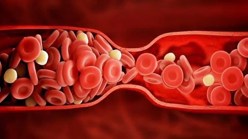 طبيب يكشف عن 5 طرق لتقليل أعداد الجلطات في المملكة