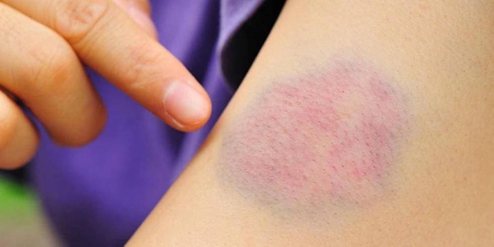 سبب تكون كدمات تحد الجلد بعد أخذ الإبر .. فيديو