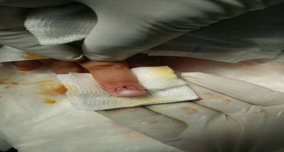 الأطباء يتمكنون من إعادة " إصبع مبتور " لطفل بمستشفى سلوى العام