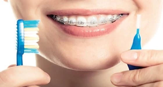 4 نصائح تساعدك في الحفاظ على أسنانك خلال " التقويم "
