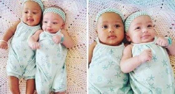 بالصور..حالة نادرة لتوائم تثير الجدل